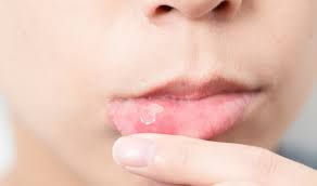 Ban miệng có thể cảnh báo mắc COVID-19